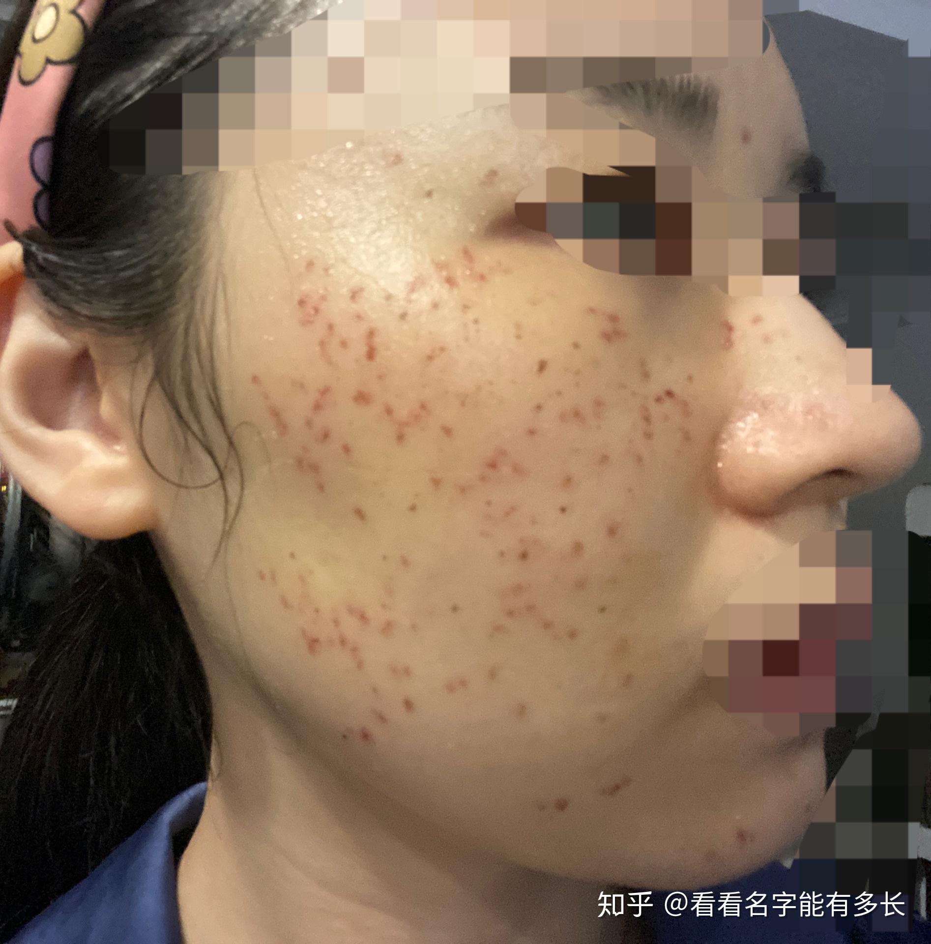 调q激光祛斑77光子嫩肤 - 知乎