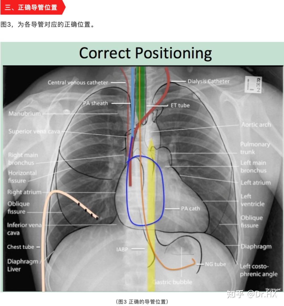 常用胸片解读和导管位置结果。 - 知乎