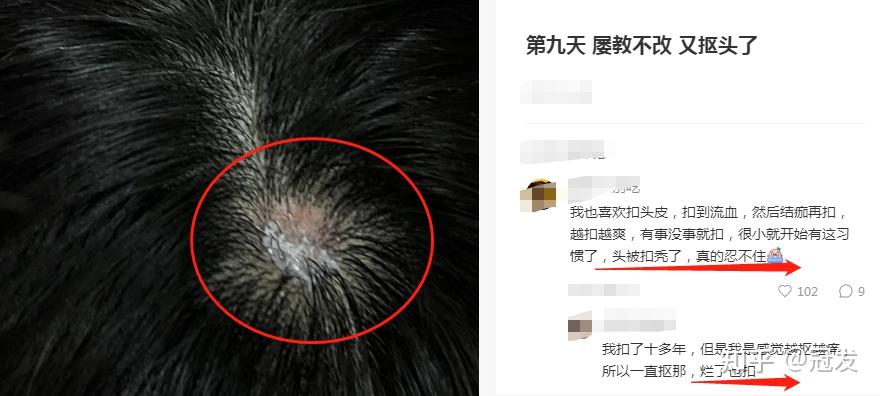 如果你有抠头皮习惯,请尽快改!(附纠正方法) - 知乎