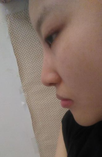 这样的鼻子该怎么整?