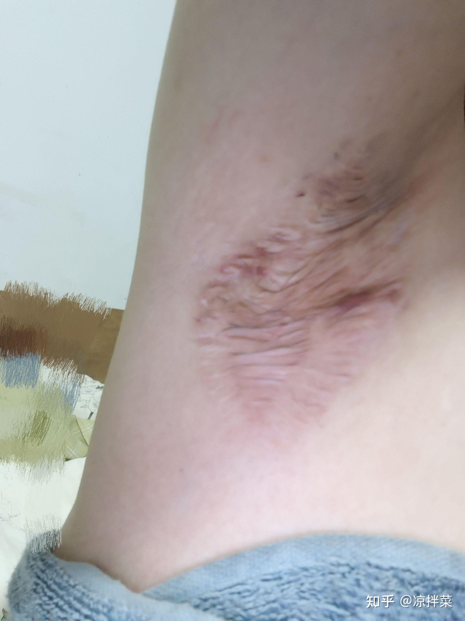 狐臭手术疤痕图图片