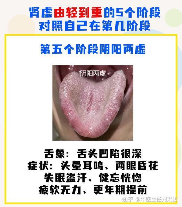 肾虚共有5个发展阶段,舌象及对应表现,对照自己发展到哪一步? - 知乎