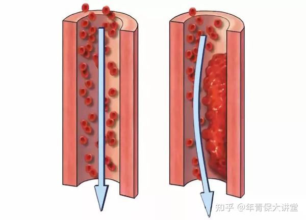 冬季血栓高发,这些方法可防栓!赶快为父母收藏! - 知乎