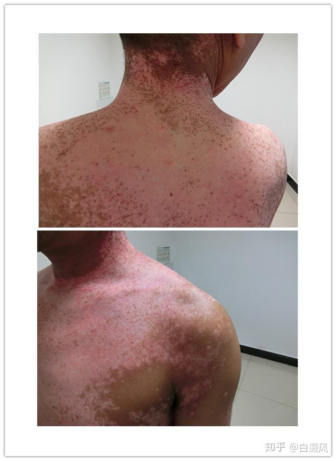 为治这个病我吃了太多苦,有一次在诊所里,大夫说有祖传的药方能治