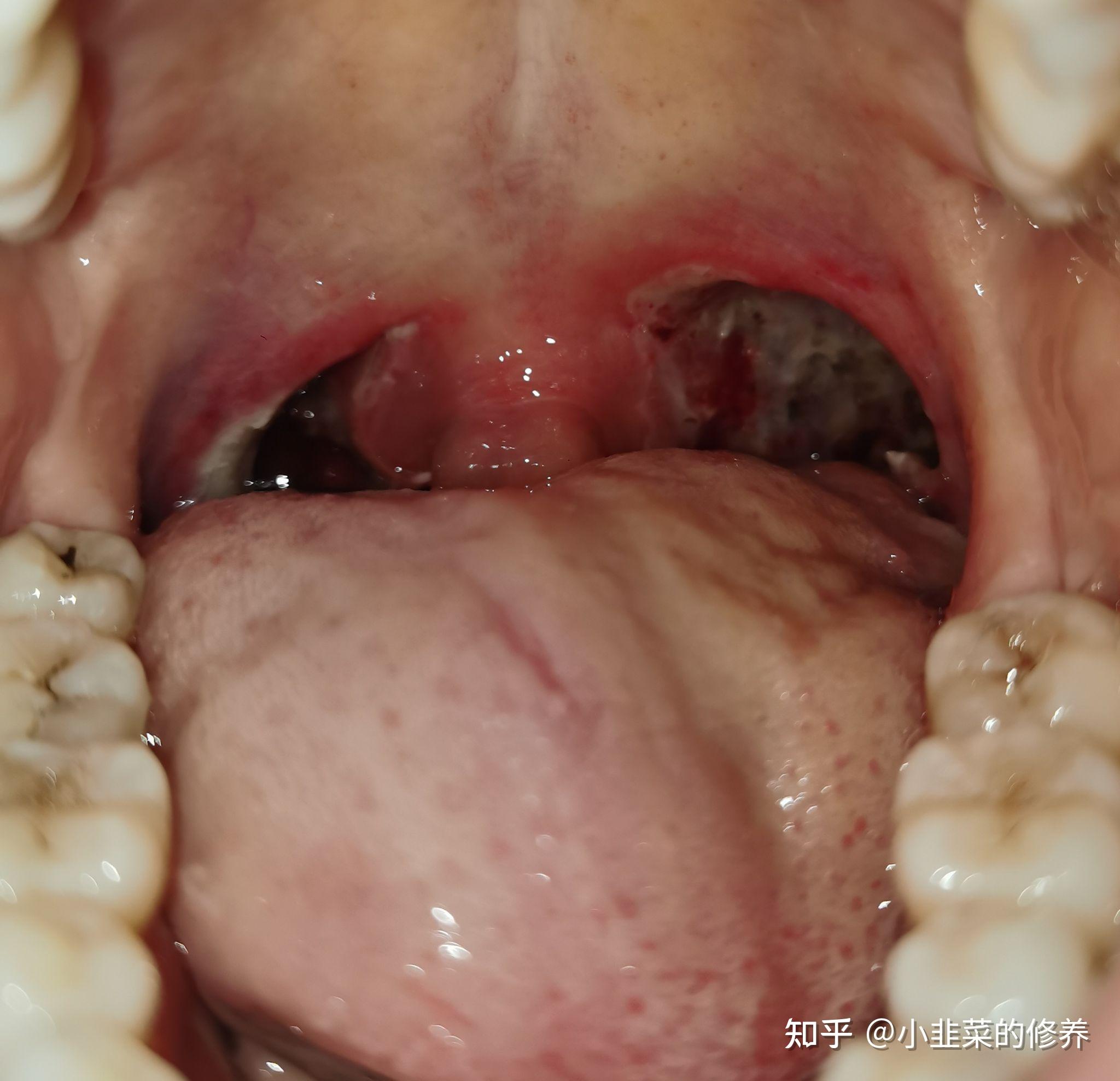 扁桃体有坑图片