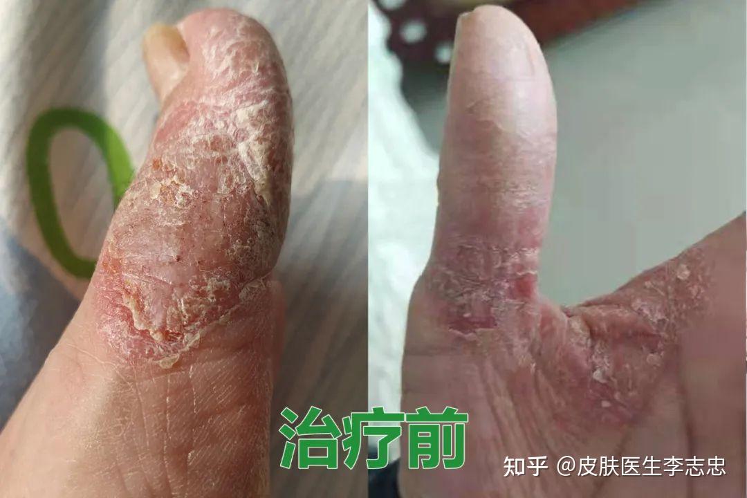 德懿堂治疗掌跖脓疱病医案一则