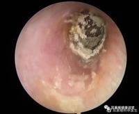 腺样体肥大的病因与典型症状有哪些