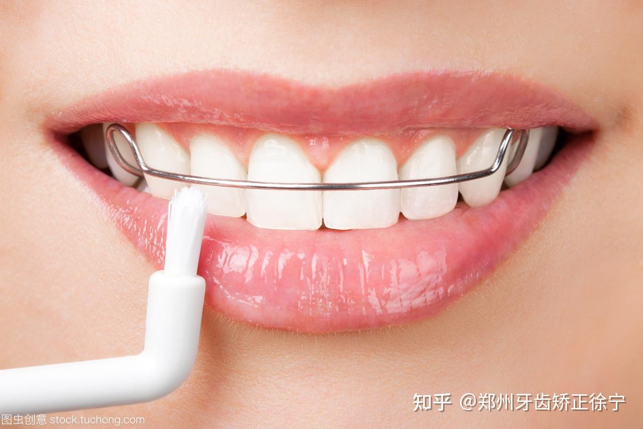 郑州牙齿矫正多久能拿掉牙套