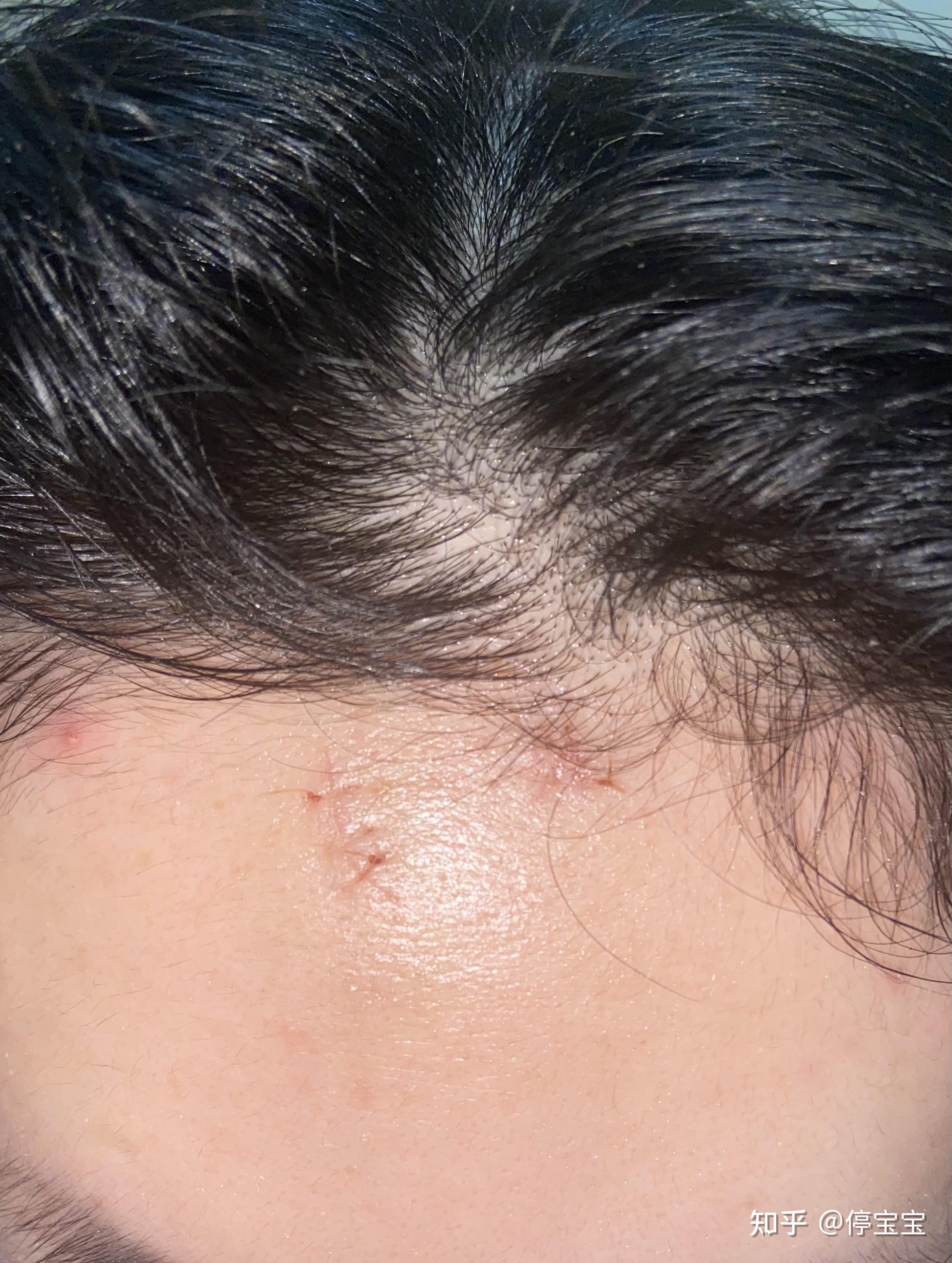 记录额头割伤疤痕的恢复过程 - 知乎