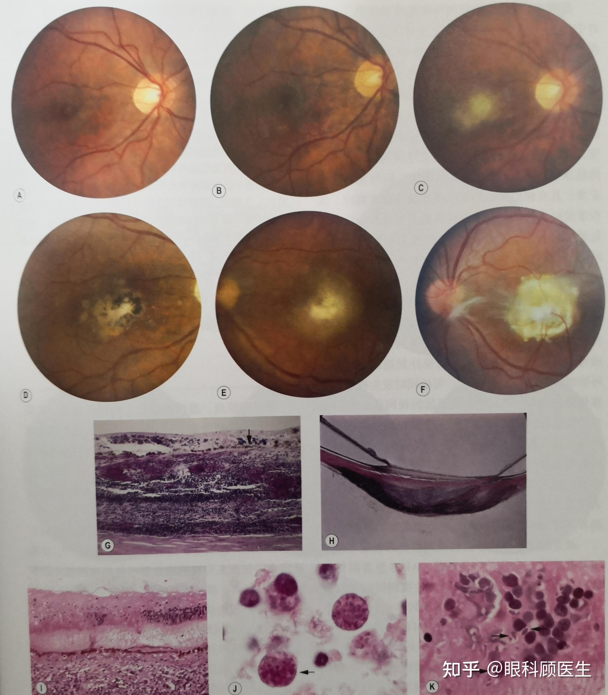 弓形虫病引起的视网膜脉络膜炎是什么样的? 