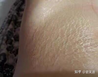 减肥后肚子上有橘皮纹怎么办? - 知乎
