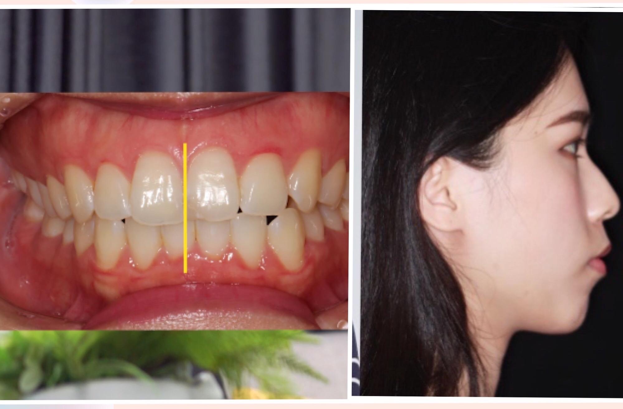 矫牙专访凸面形颏部偏斜骨性错颌畸形其他医生需要正颌手术的问题舌侧