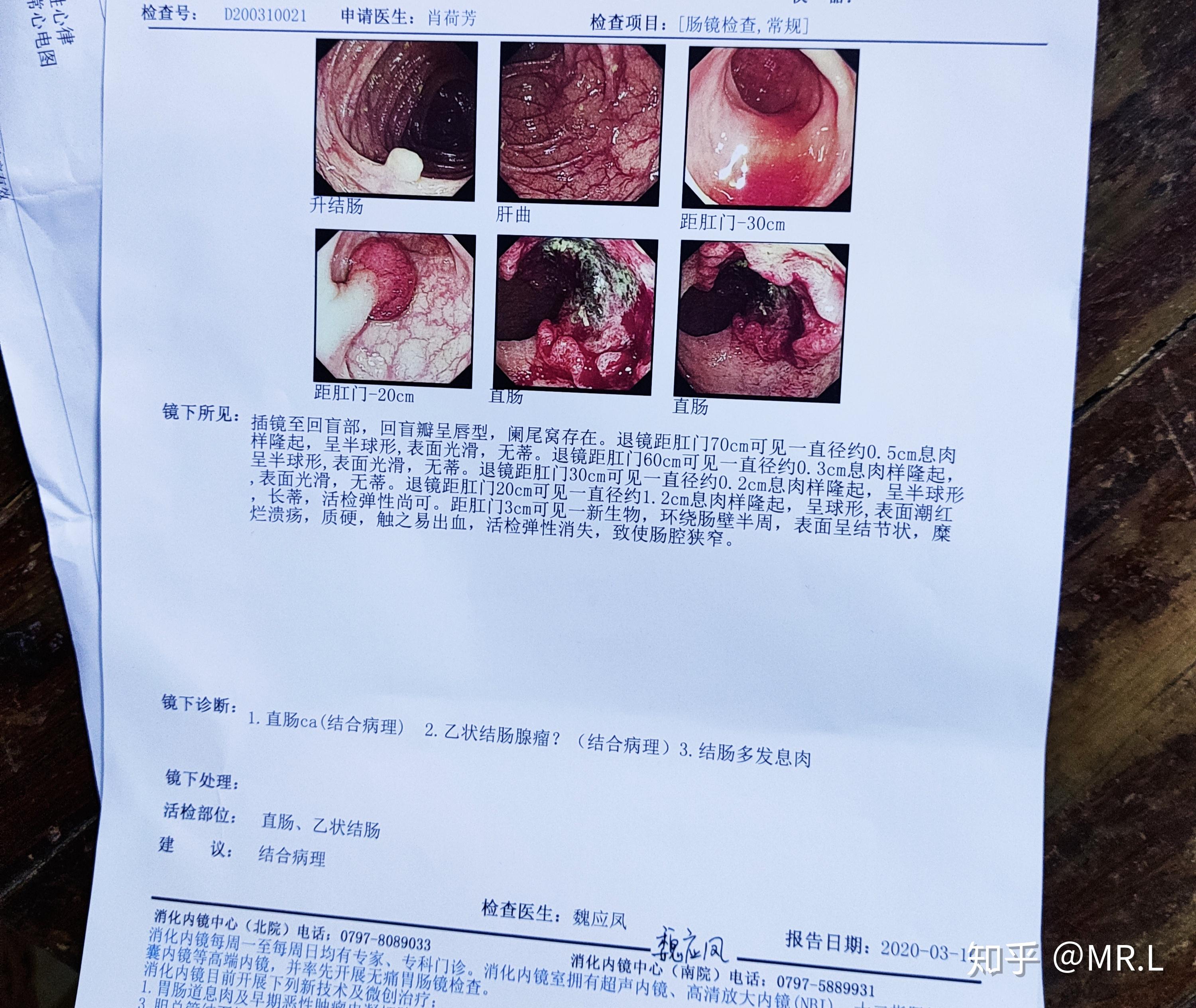 结肠癌报告图片