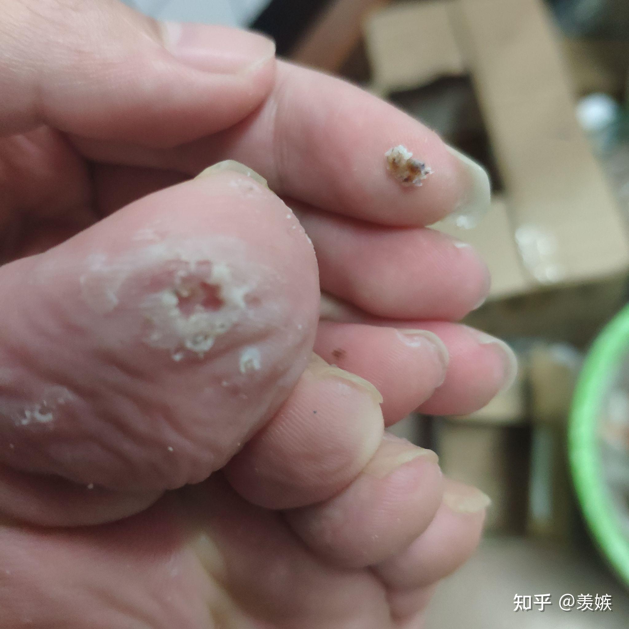 中间涂药绑脚的过程没拍,中间的时候那个跖疣黑色的肉刺特别突出,我看