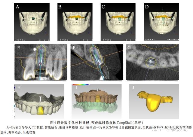 数字化预成临时修复体TempShell在种植即刻修复中的应用 - 知乎