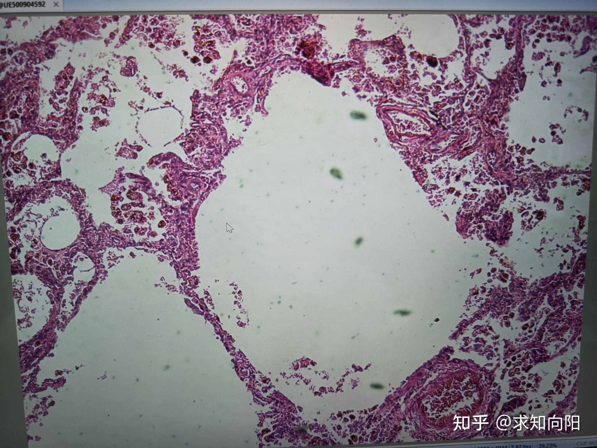 慢性肺淤血病理图图片