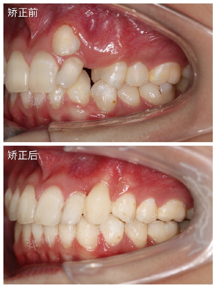 除此之外,她还有一颗侧切牙为畸形牙(过小牙),后期我还将对它进行根唇