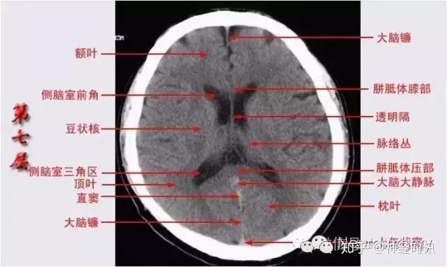 解剖&影像 —— 颅脑CT解剖口诀及彩色解剖图 - 知乎
