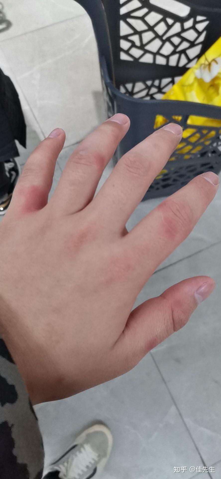 三次了,浑身痒,手上脚上长红色的斑,每次去医院医生也只是说皮疹,皮炎