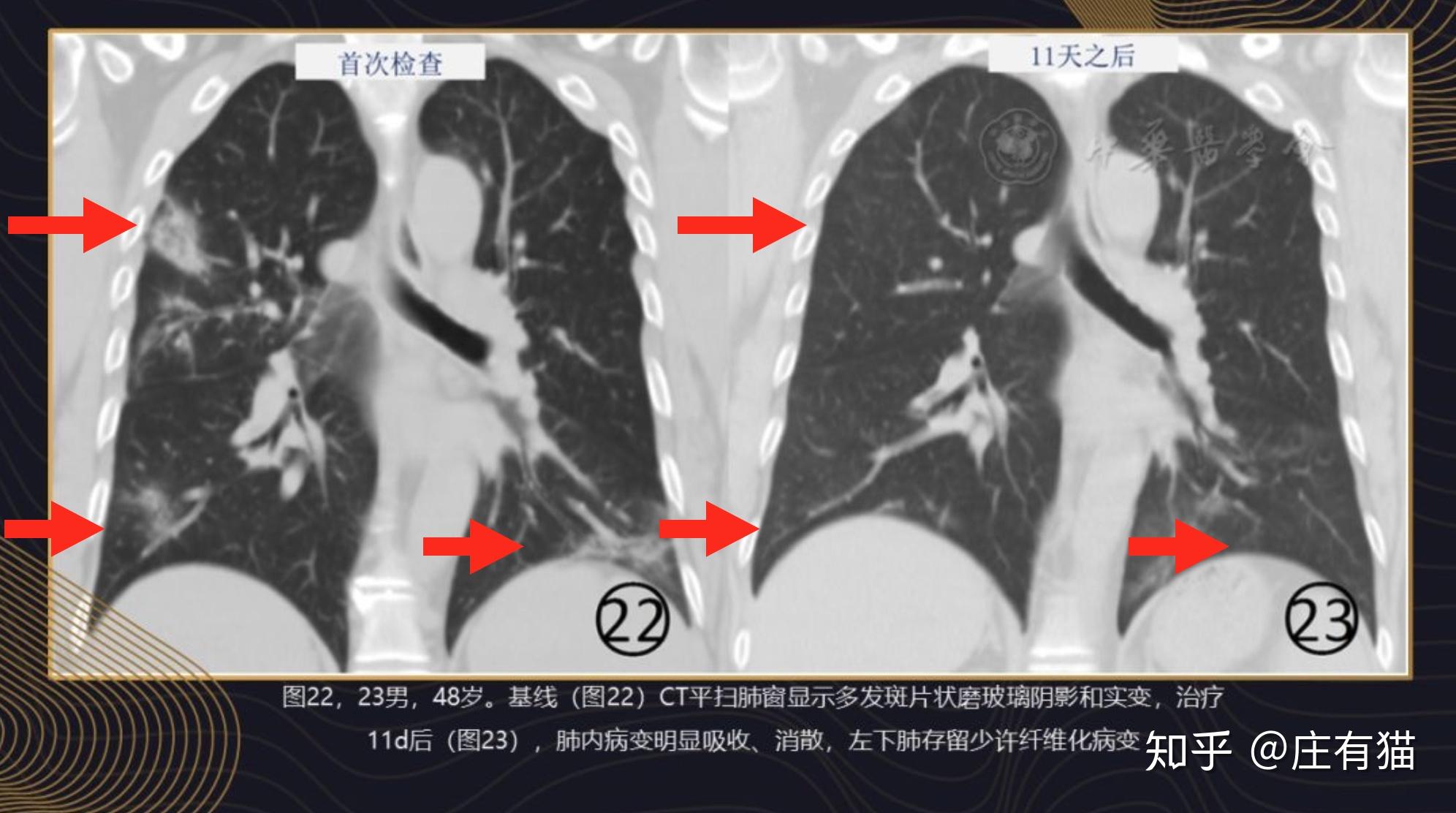 常见病毒性肺炎的影像学特征︱图文并茂_病毒性肺炎影像学特征_医脉通