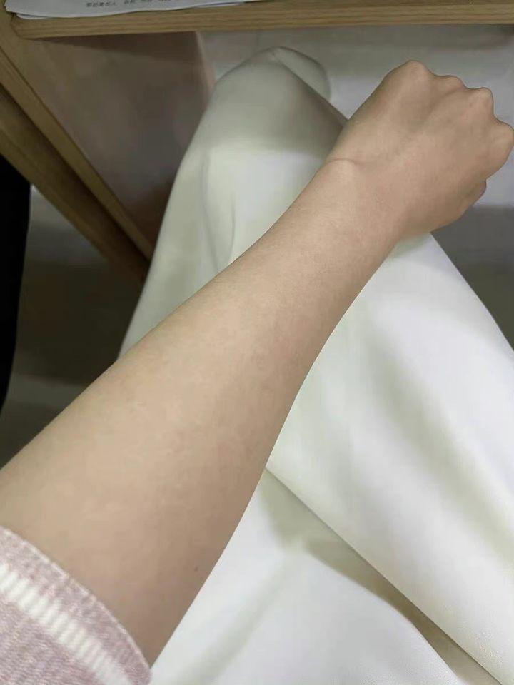 紫外线照射可以治疗鸡皮肤(紫外线照射可以治疗鸡皮肤吗)