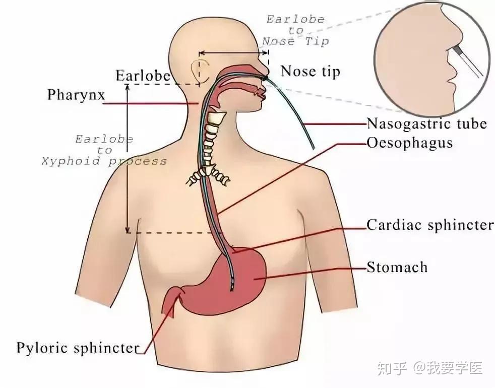 脑卒中吞咽障碍患者拔除鼻胃管时机与标准