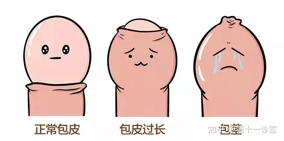 香蕉大家都吃过吧,包皮过长呢,就像香蕉包着皮,但是很容易剥开,可以