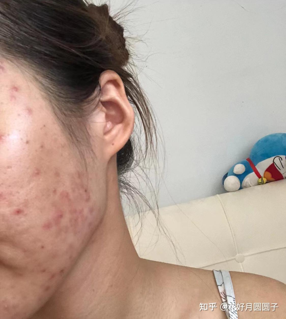 毕竟在肛肠科科实习,连便秘都治不好,我实在没脸带在科室里啊!