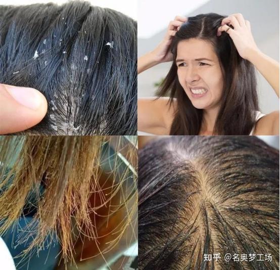 头发受损卡梳推荐油屑痒干枯毛躁分叉居家spa拯救发质受损纵享丝滑