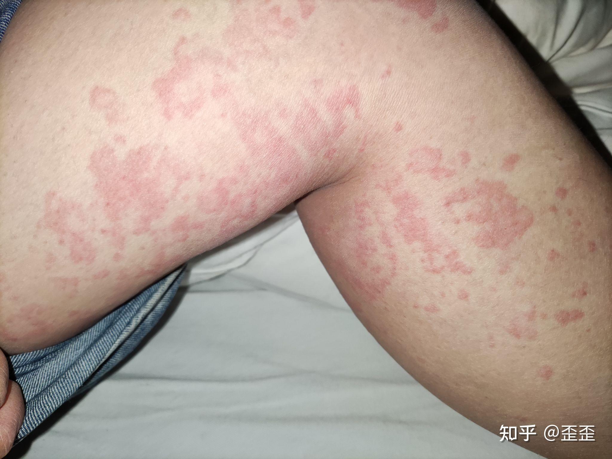 不知道是不是荨麻疹
