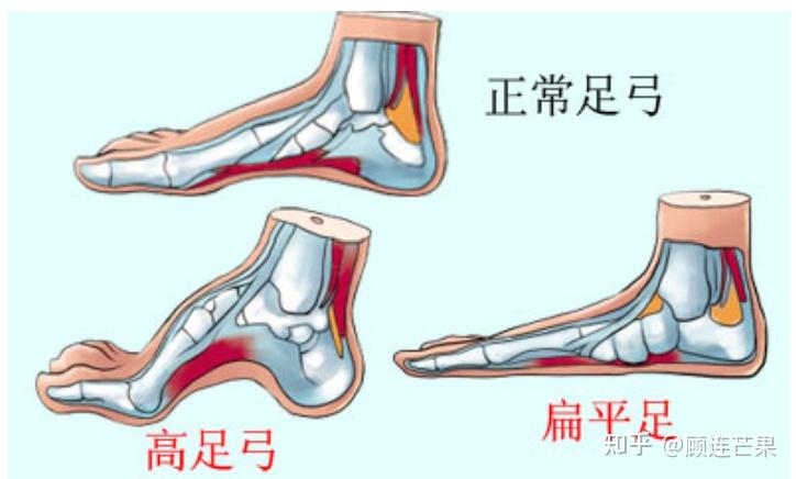 顾连芒果科普 | 关于扁平足,你需要了解的一些小科普 - 知乎