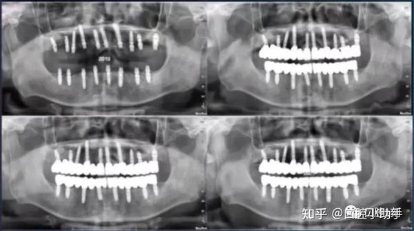 【云上课堂】课程回顾|口腔种植修复中基台的选择、趋势与发展 - 知乎