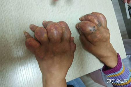 痛风病友:四大影像学检查技术帮你看清痛风对骨质的破坏!