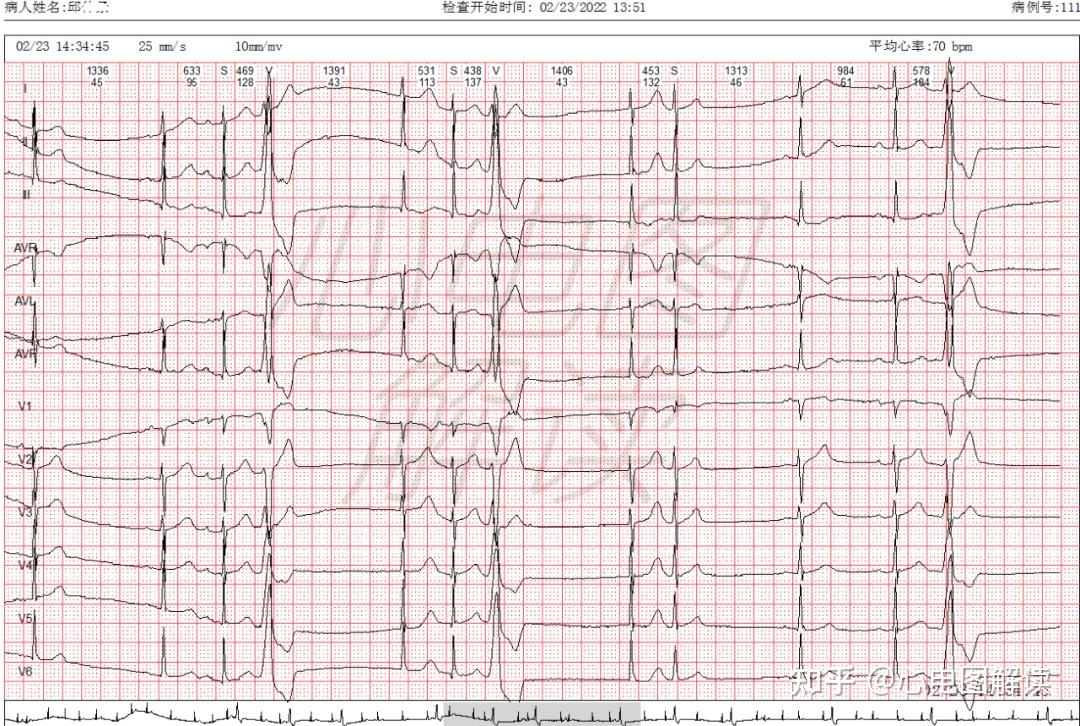 室性早搏.2.房性早搏,1.