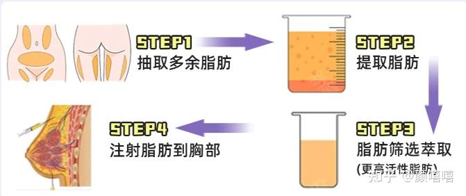 80產後寶媽面臨的胸部下垂問題如何進行醫學修復產後隆胸手術值得做嗎