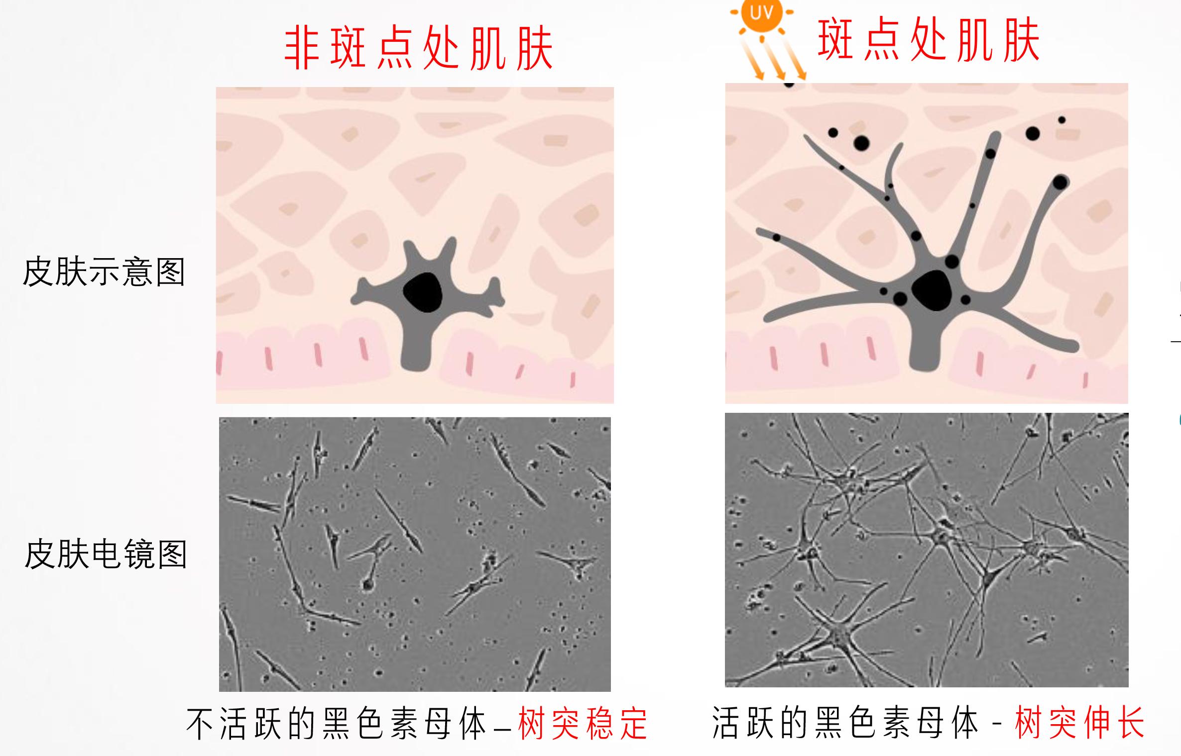 其实,斑点和痘印难以解决的元凶就在于:黑色素细胞(也称黑色素母体)
