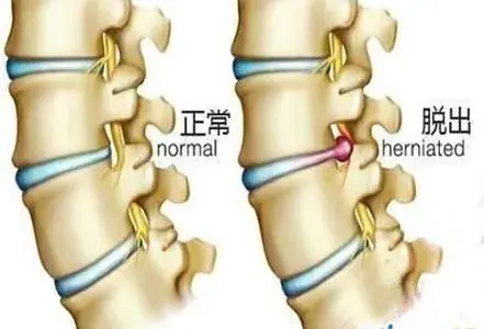 给脊柱减减压:脊柱微分动力疗法