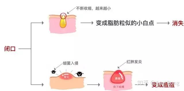 闭口痘痘总是冒?这可能是最全最有效的去闭口指南了! - 知乎