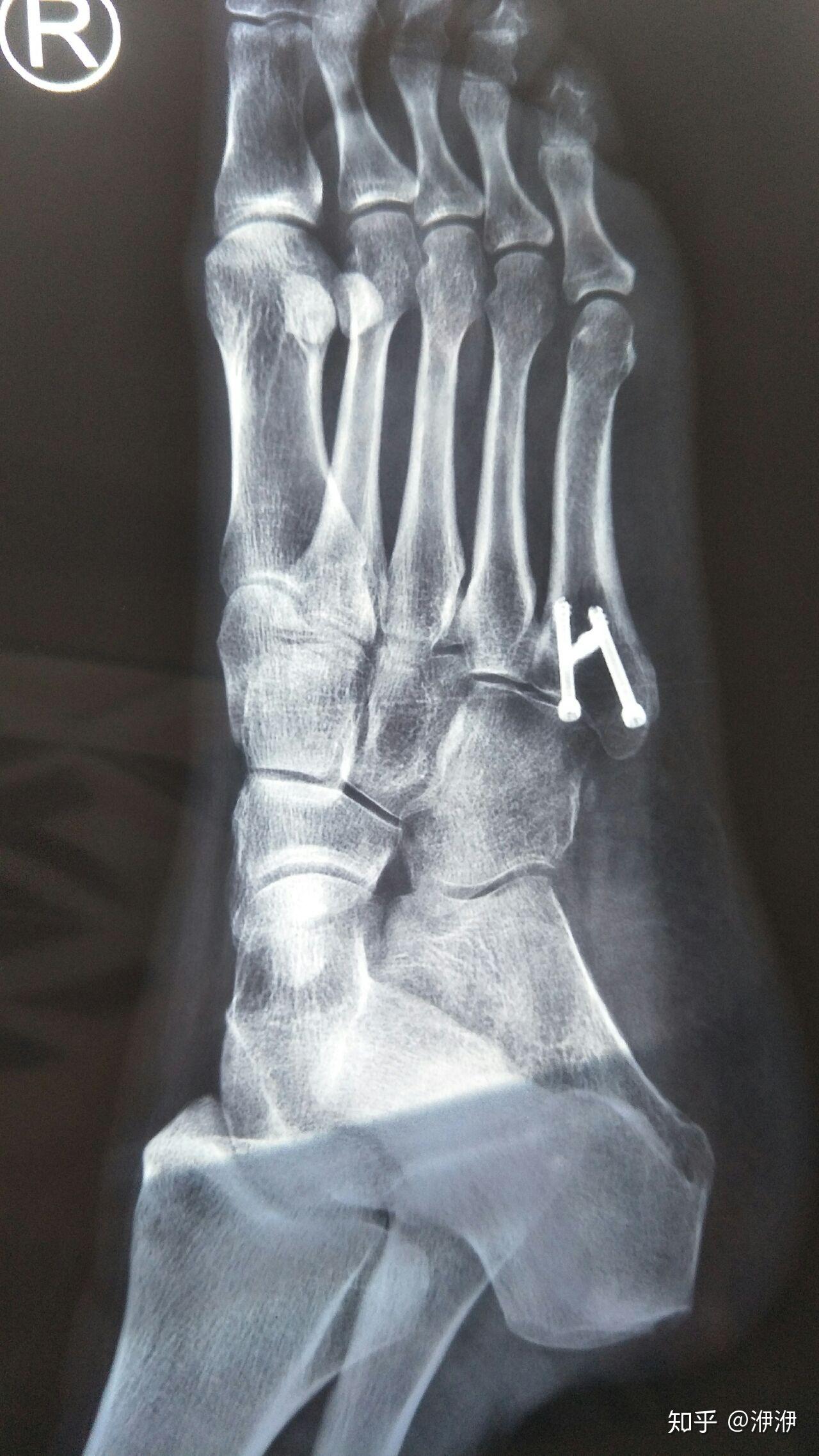 记录右脚第五跖骨骨折恢复过程