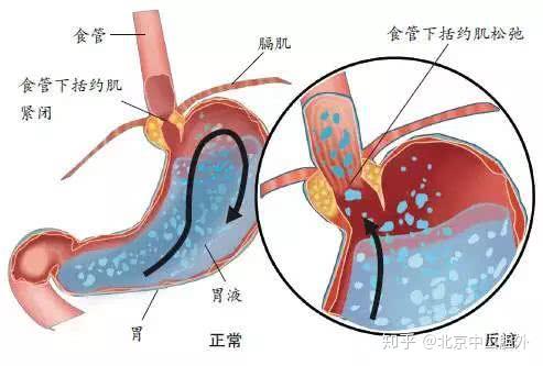 早上起来为什么会恶心干呕 原来是这三种原因 知乎