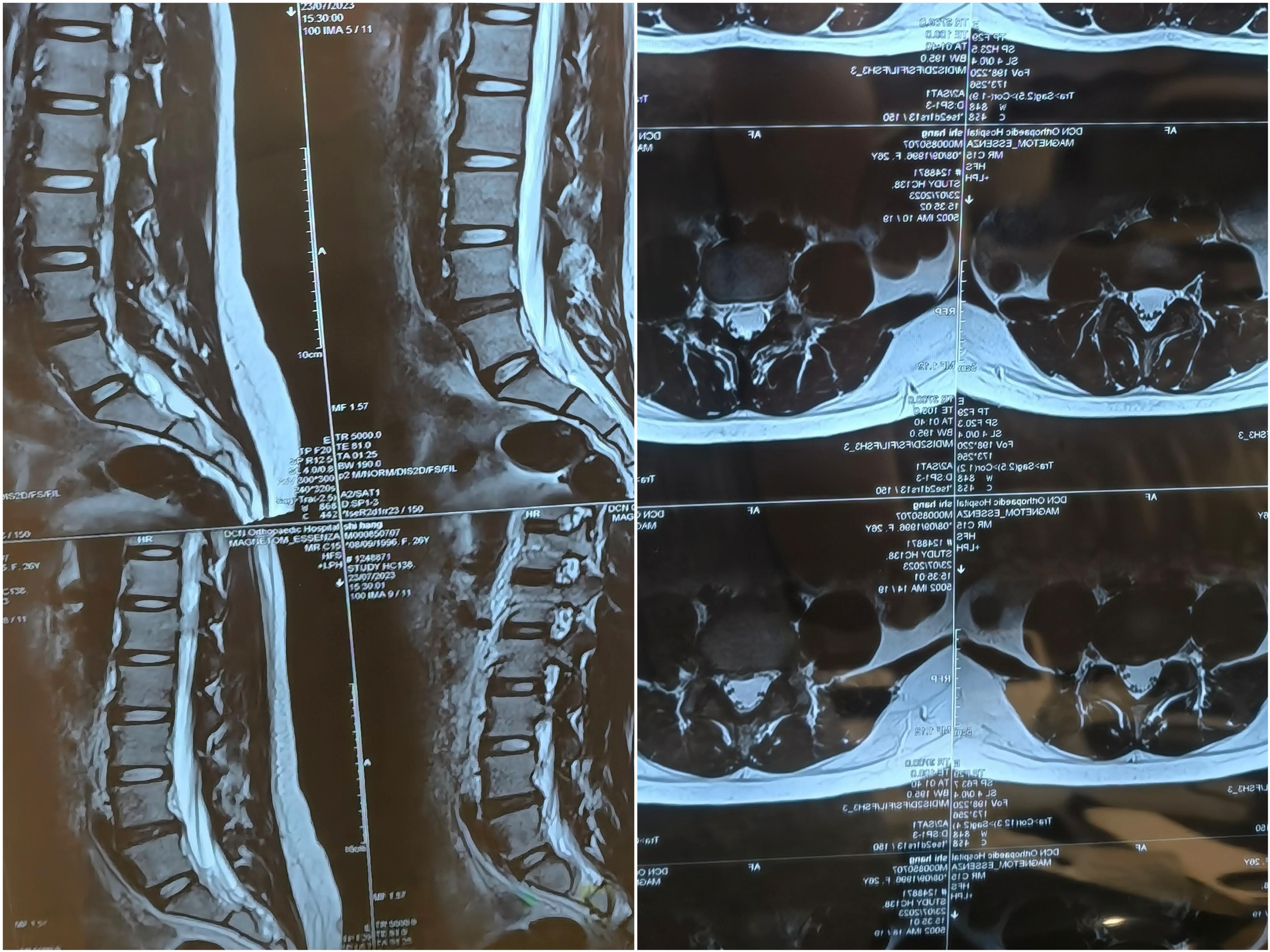图4-15 脊神经根与椎间盘的关系-临床解剖学-医学
