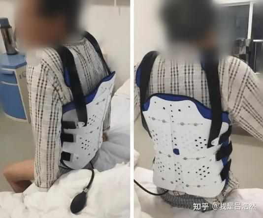 腰椎骨折如何恢复