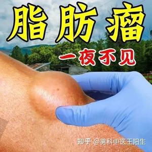 脂肪瘤(痰核),推荐2味药消得无影无踪 - 知乎