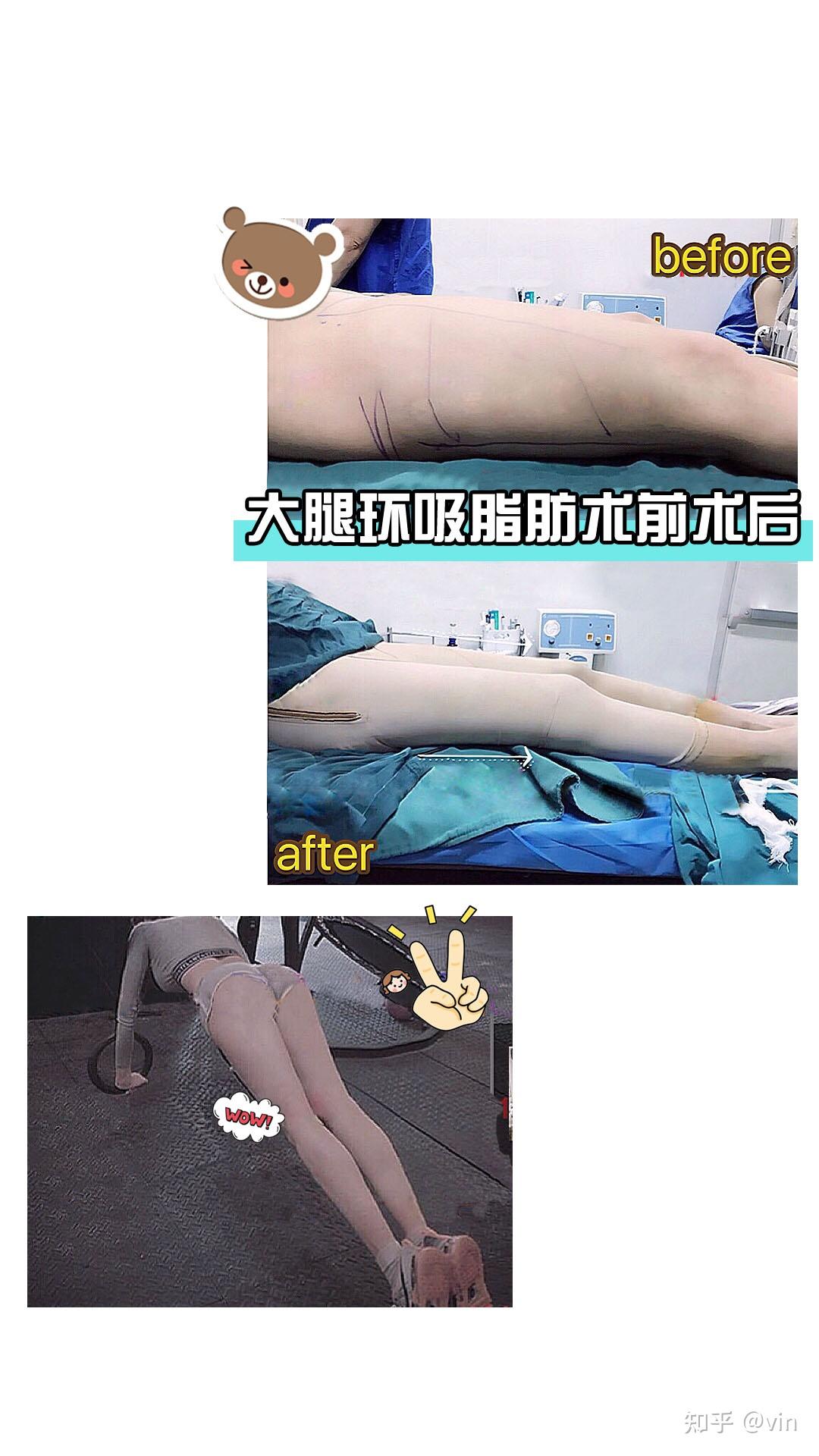 韩国一路美整形外科吸脂瘦大腿怎么样_恢复过程_效果如何_三三喵了个喵整形日记9.22_新氧美容整形