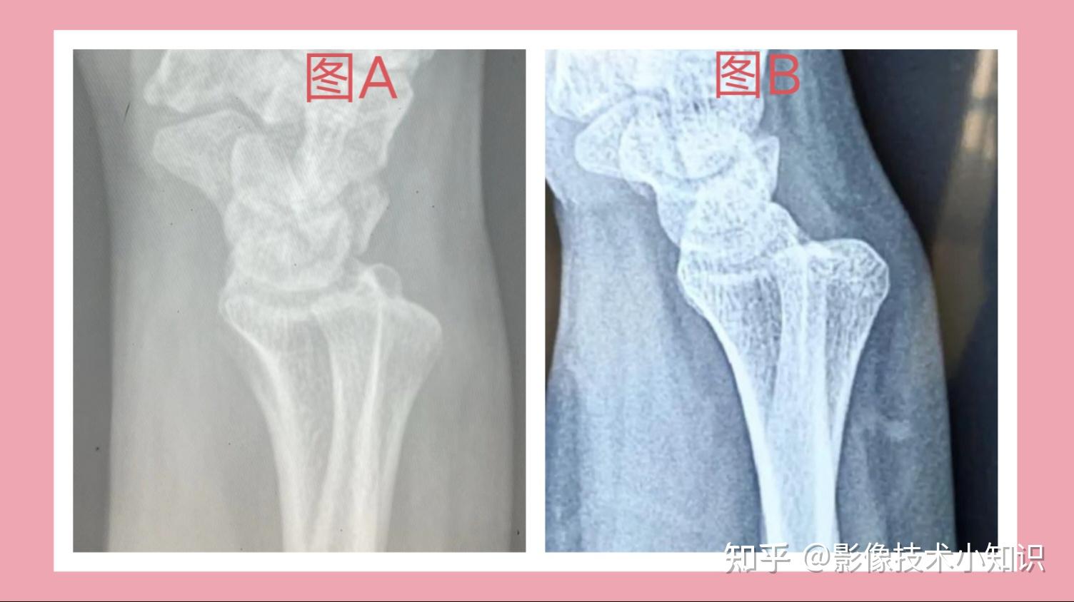 腕关节侧位片图片