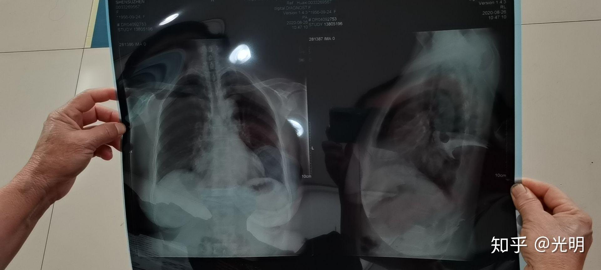 肺部CT显示前纵隔见高密度影。是什么意思？ 做胸透报告显示:前上纵隔