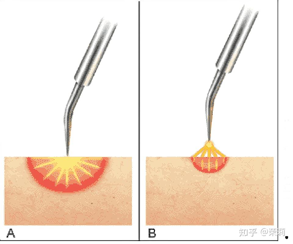 电解法治疗汗管瘤 知乎