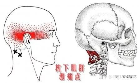 金門美兆診所 ''枕下肌症候群
