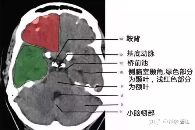 解剖&影像 —— 颅脑CT解剖口诀及彩色解剖图 - 知乎