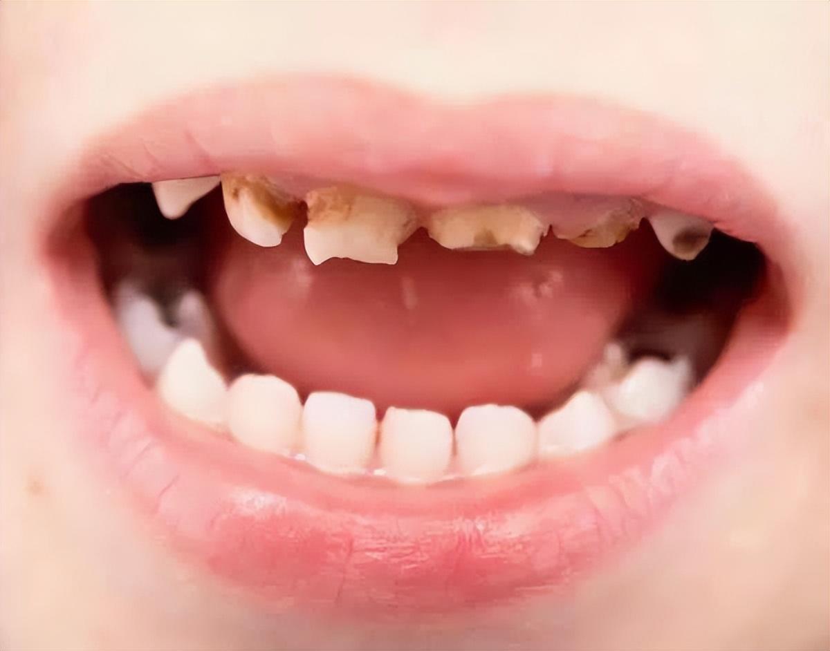 虫牙图片严重蛀牙,虫牙蛀牙黑牙图片,虫牙的图片蛀牙_大山谷图库